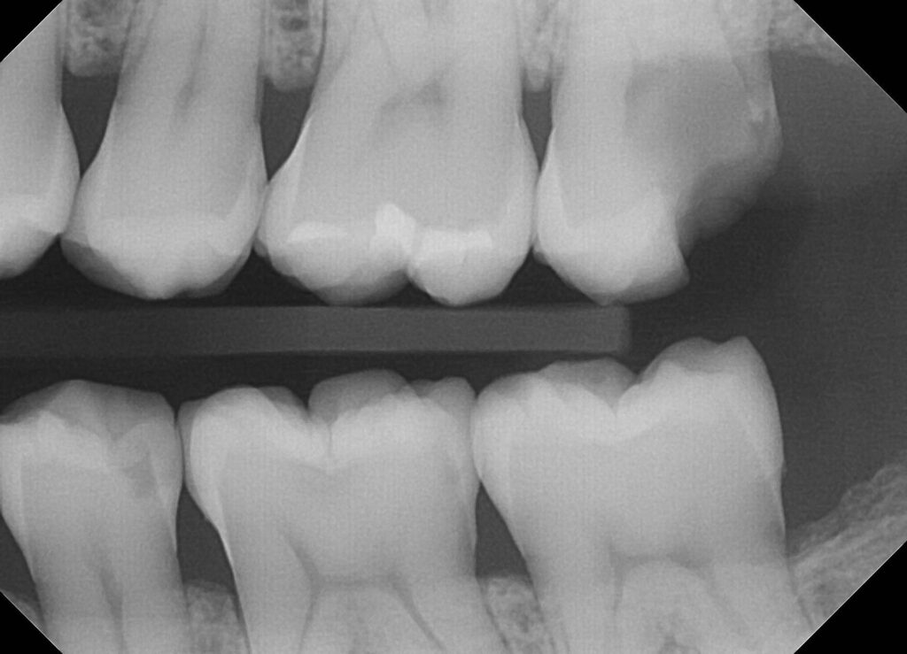 Large cavity in tooth #15